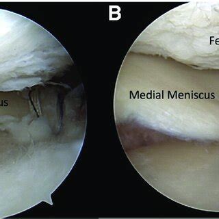 Arthroscopic Image Of A Left Knee With A Arthroscope Viewing From A