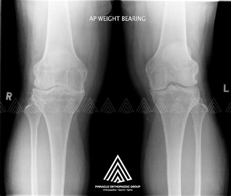 Total Knee Replacement Surgery Singapore Joint Surgeon