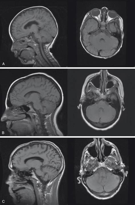 Endoscopic Management Of Clival Chordomas And Chondrosarcomas