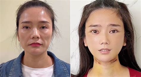 Plastic Surgeon Dr Kim Goes Viral On Tiktok For Dramatic Before And