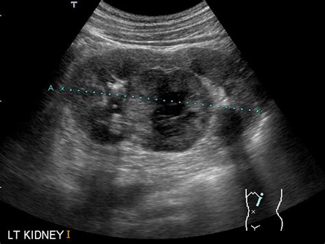 Renal Oncocytoma Eurorad