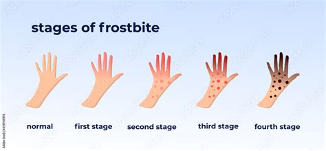 Frostbite stages. Hypothermia in cold season. Medical infographic. Blue and red fingers ...