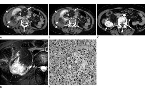 Figure 1 From Concurrent Renal Angiomyolipoma And Renal Cell Carcinoma