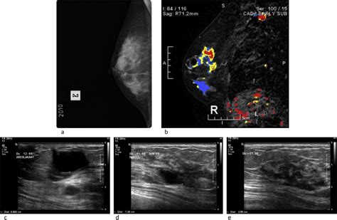 The Accuracy Of Incremental Pre Operative Breast Mri Findings