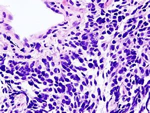 Small cell carcinoma of the lung - Libre Pathology