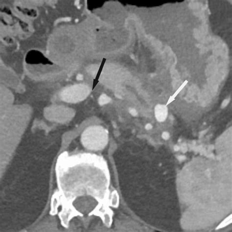 Vascular complications in a 43-year-old female with severe necrotizing... | Download Scientific ...