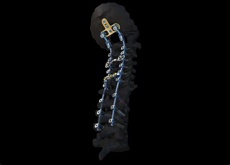 New Cervical Spine System from DePuy Synthes Advances Treatment Options