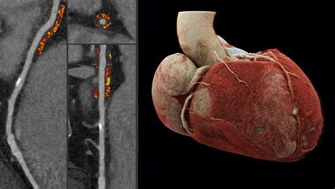 Frontiers Computed Tomographybased Pericoronary Adipose Tissue