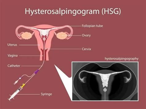 What Is An Hsg Hysterosalpingogram Fertility Evaluations