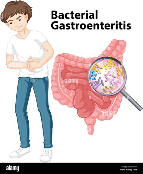 Gastroenteritis Hi Res Stock Photography And Images Alamy