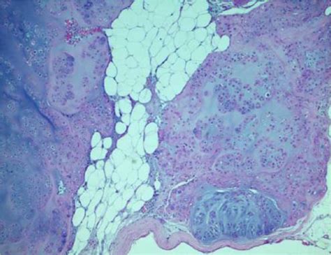 Histopathologic Section Shows Nodules Of Cartilaginous Tissue