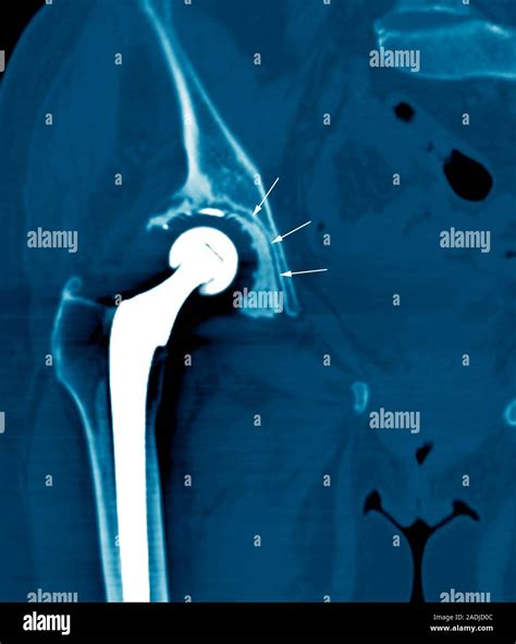 Loosened Hip Replacement Coloured Computed Tomography CT Scan Of The