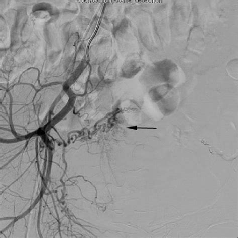 Left Internal Iliac Arteriogram Shows Postembolization Of The Left