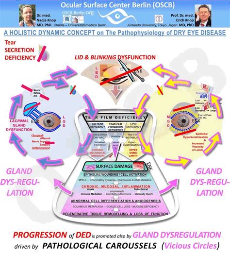 Overview How Dry Eye Gets Worse Ocular Surface Center Berlin