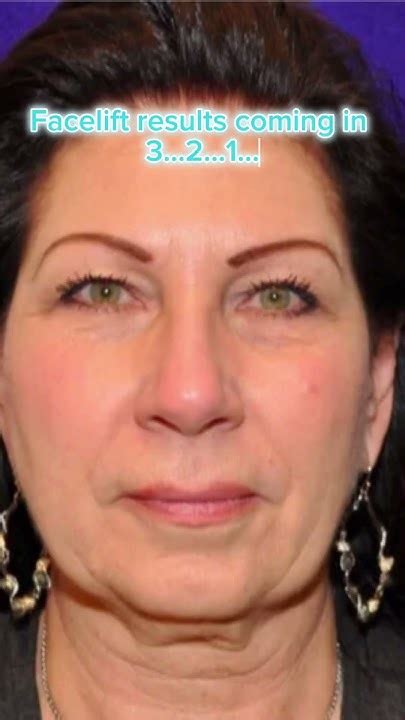 Facelift Results Dr Tanveer Janjua New Jersey Youtube