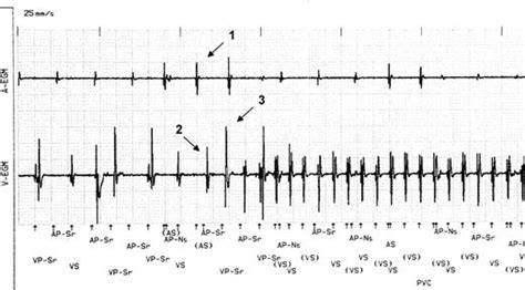 Stored Intracardiac Cardiogram Showing Pacemaker Induced Ventricular Tachycardia After Normal