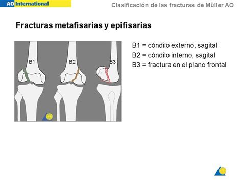 Clasificaci N De Las Fracturas De M Ller Ao Clasificaci N Ao De M Ller