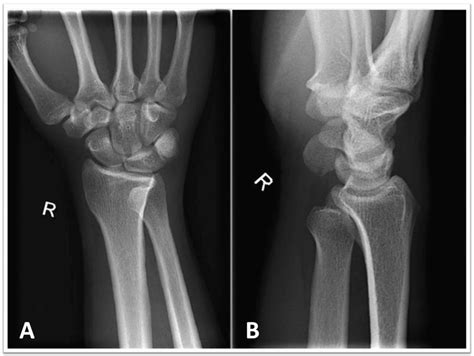 Two Views Anteroposterior And Lateral Of The Distal Biceps Tendon Hot Sex Picture