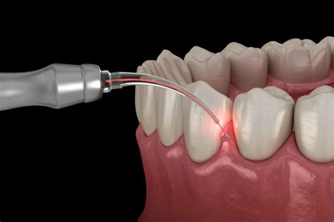 Types Of Gum Surgery And Why You Might Need One