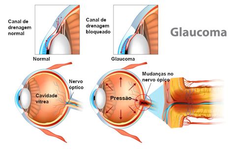 Glaucoma O Que Tipos Sintomas E Tratamento Mundo Educa O