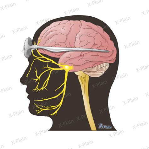 Transcutaneous Supraorbital Nerve Stimulation