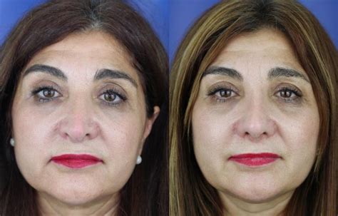 Rinoplastia Para Nariz Ancha Ramón Terré