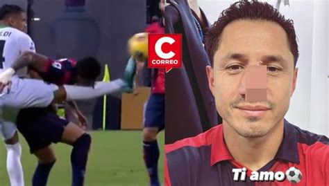 Vuelven A Romperle La Nariz A Gianluca Lapadula Pero Anota Y Se