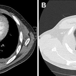 Chest Ct Scan Showing A Bilateral Pleural Effusions And B A