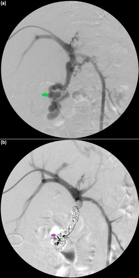 A Transhepatic Portal Venogram Demonstrating Large Duodenal Varix