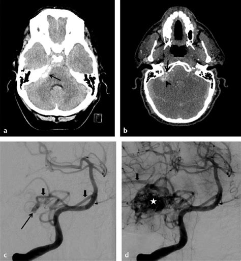 Preoperative And Postoperative Imaging Evaluation Of Arteriovenous Malformations Neupsy Key