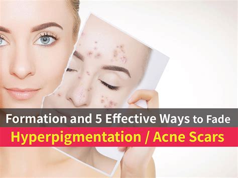 Formation and 5 Effective Ways to Fade Hyperpigmentation/Acne Scars