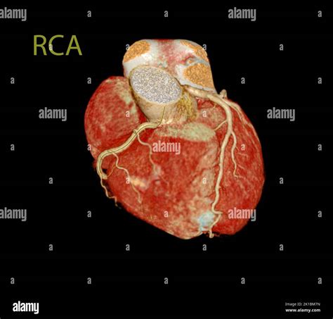 Heart Angiogram With Balloon Hi Res Stock Photography And Images Alamy