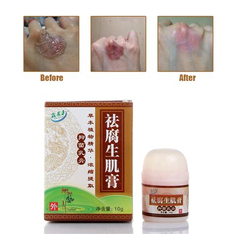 Skin healing ointment,wound Cream Bedsores Paste Treat Pressure Sores ...