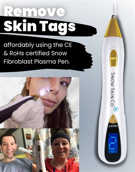 Snow Fibroblast Plasma Pen for Skin Tags - Shop Now – Snow Skin Co® The ...