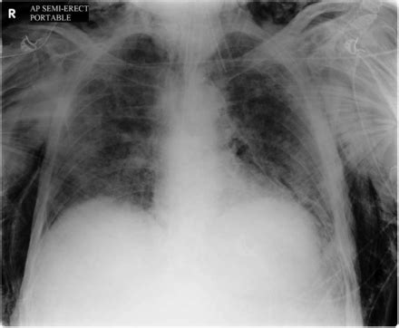 Subcutaneous Emphysema Bmj Case Reports