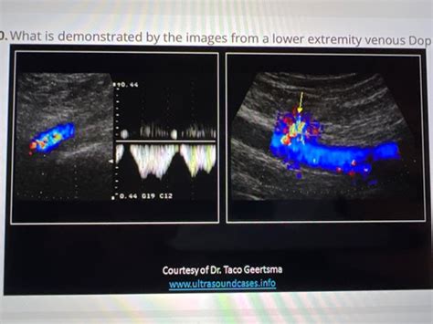 CCI Vascular Sonography Mock Exam A20 Flashcards Quizlet