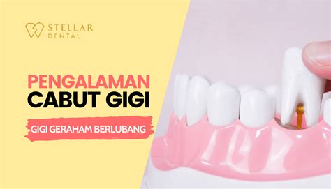 Cabut gigi berlubang Archives - Stellar Dental