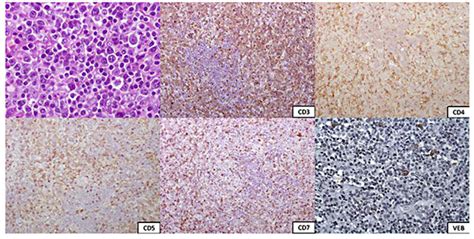 Immunohistochemical Staining Of An Axillary Lymph Node Biopsy Cd3 Download Scientific Diagram