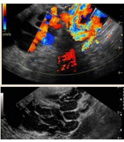 Pelvic Congestion Syndrome Pelvic Congestion Syndrome Obgyn Ultrasound