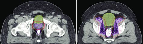 Contouring Of Target Volumes And Organs At Risk A CTV P SV Pink