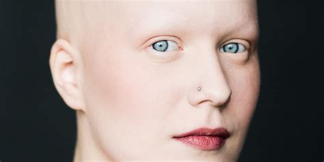 Female Alopecia