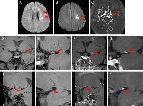 Representative Brain Mri Findings Of A Stroke Patient With Intracranial