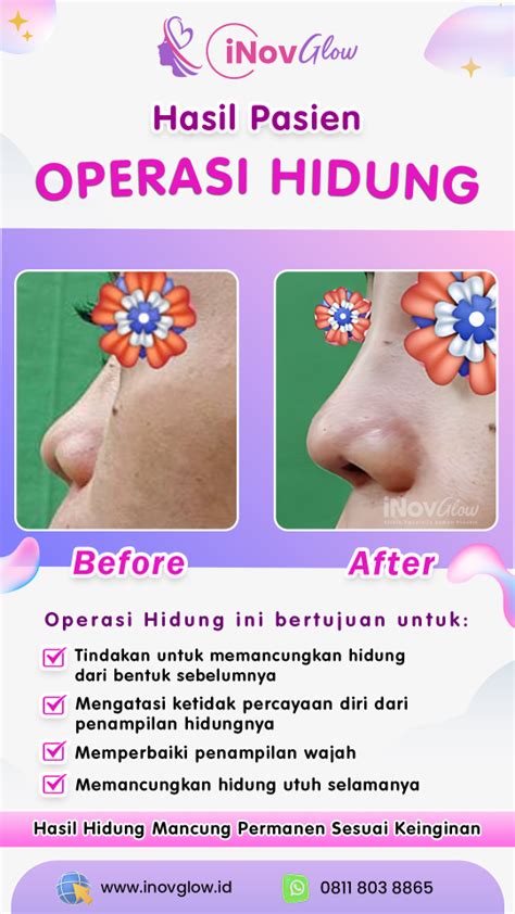 3 Jenis Operasi Hidung Yang Perlu Diketahui INOVGLOW KLINIK