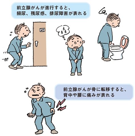 前立腺がんの症状 痛み