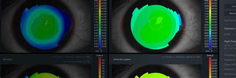 Zeiss Presbyopia Management Assess And Educate