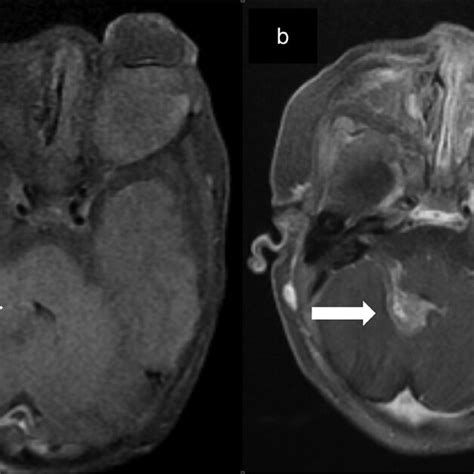 A Axial T Weighted Image And B Axial T Postcontrast Mr Showing A