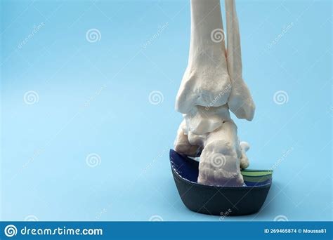 Anatomical Model Of The Bones Of The Foot Wearing An Orthopedic Insole