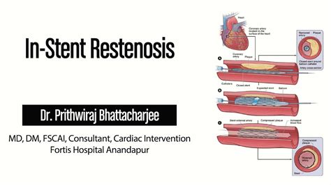 IN STENT RESTENOSIS YouTube