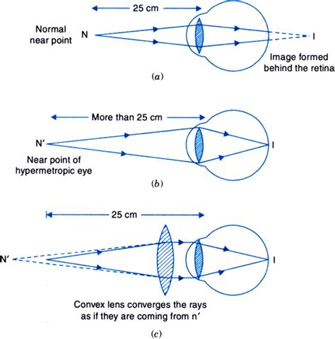 What Is Hypermetropia And Also Write Cause Symptom And Correction