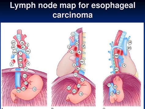 Stage 2 Cancer Lymph Nodes